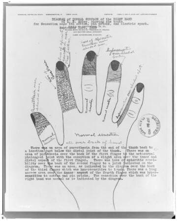 A1.1 Personal Injury-Accident - Diagram of back of right hand