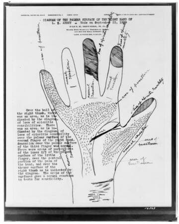 A1.1 Personal Injury-Accident - Diagram of palm of right hand