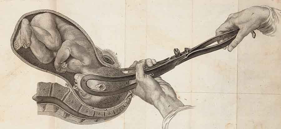 Illustration of a baby being delivered with forceps from Jean-Louis Baudelocque’s L’art des accouchemens, 1781.