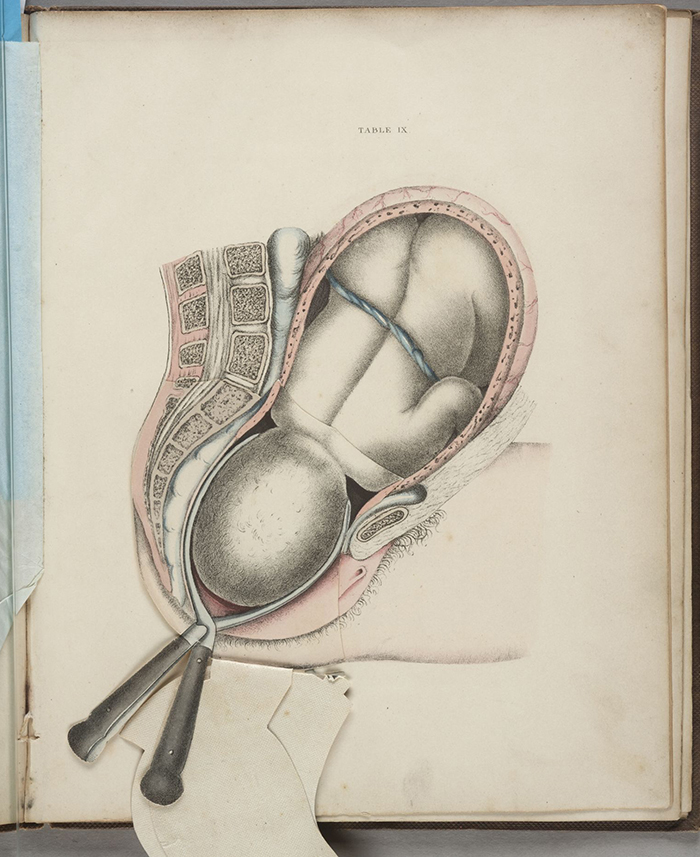 19th-century obstetrics textbook